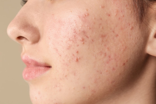 acne-prone skin, what is skincare
